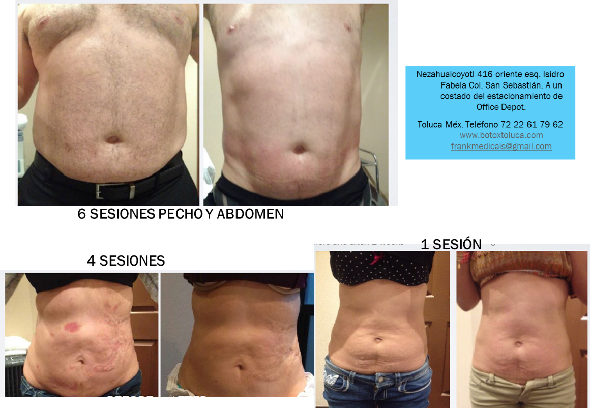 mesoterapia y reducción de grasa corporal mesoterapia y reducción de grasa corporal